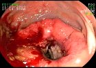 Adenocarcinoma de Recto Px de 28 A